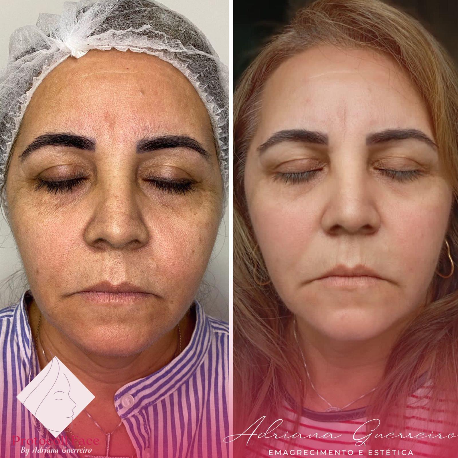 Antes e Depois — Limpeza facial profunda