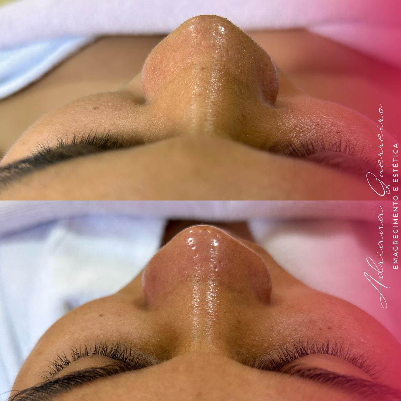 Antes e Depois — Facial personalizado